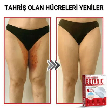 Neatify Benstop Mikro İğneli Ben Ve Siğil Düşürücü Bant – 5 Günde İz Bırakmadan Düşürür