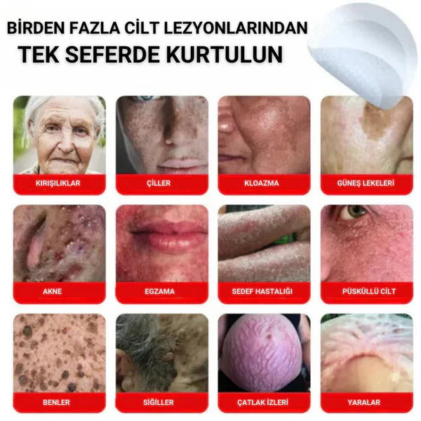 Neatify Benstop Mikro İğneli Ben Ve Siğil Düşürücü Bant – 5 Günde İz Bırakmadan Düşürür