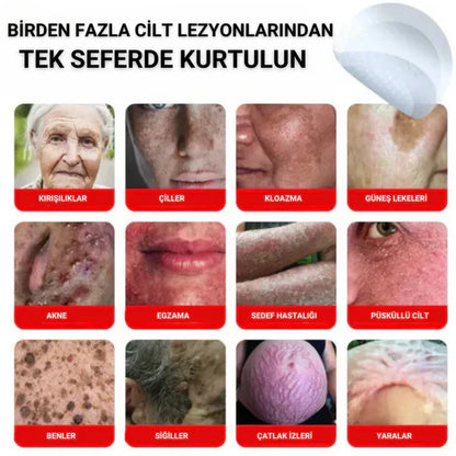 Neatify Benstop Mikro İğneli Ben Ve Siğil Düşürücü Bant – 5 Günde İz Bırakmadan Düşürür