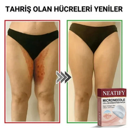 Neatify Benstop Mikro İğneli Ben Ve Siğil Düşürücü Bant – 5 Günde İz Bırakmadan Düşürür