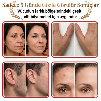 Neatify Benstop Mikro İğneli Ben Ve Siğil Düşürücü Bant – 5 Günde İz Bırakmadan Düşürür