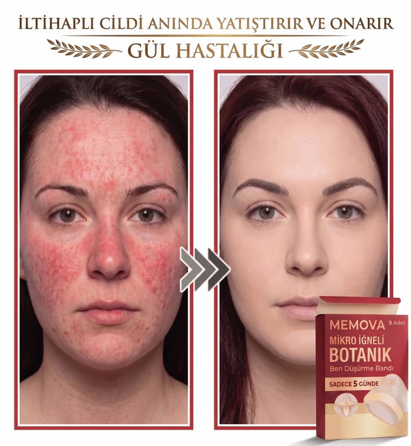 Neatify Benstop Mikro İğneli Ben Ve Siğil Düşürücü Bant – 5 Günde İz Bırakmadan Düşürür