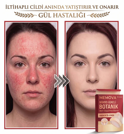 Neatify Benstop Mikro İğneli Ben Ve Siğil Düşürücü Bant – 5 Günde İz Bırakmadan Düşürür